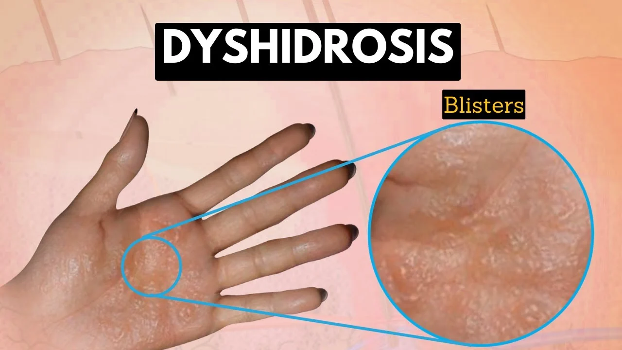 DYSHIDROSIS