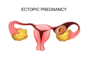 ECTOPIC PREGNANCY