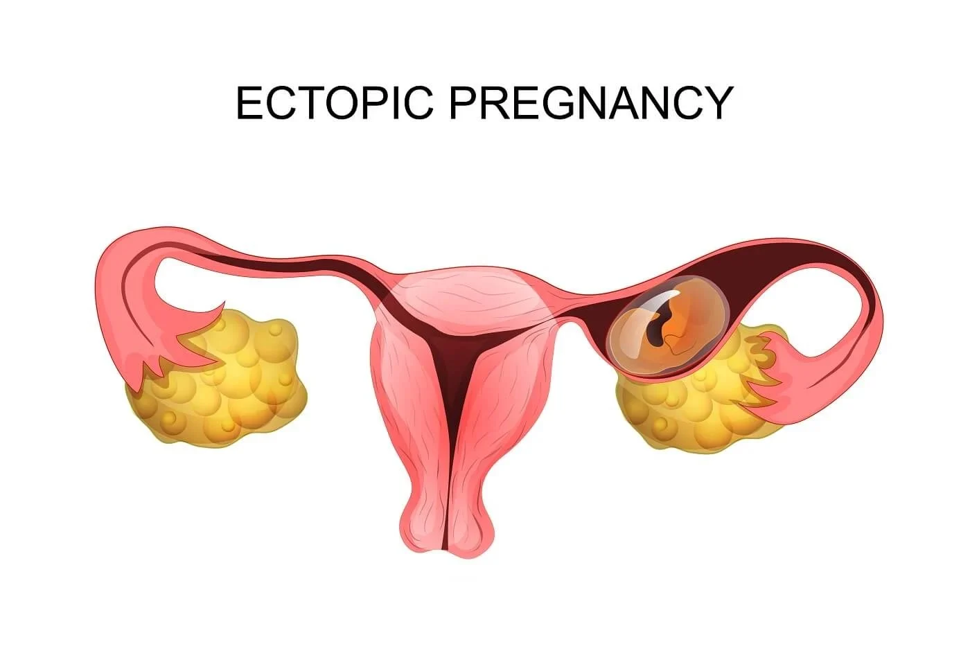 ECTOPIC PREGNANCY