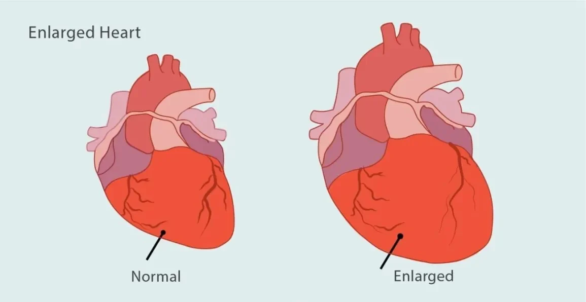 ENLARGED HEART