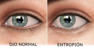 ENTROPION