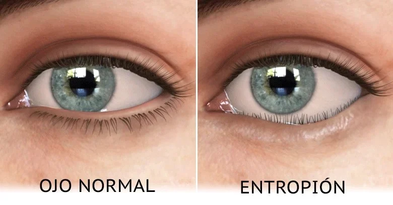 ENTROPION