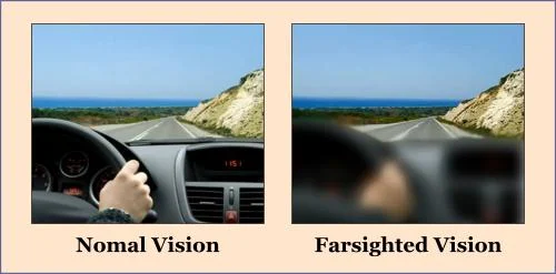 FARSIGHTEDNESS