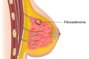 FIBROADENOMA