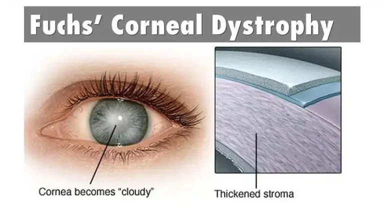 FUCH'S DYSTROPHY