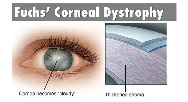FUCH'S DYSTROPHY