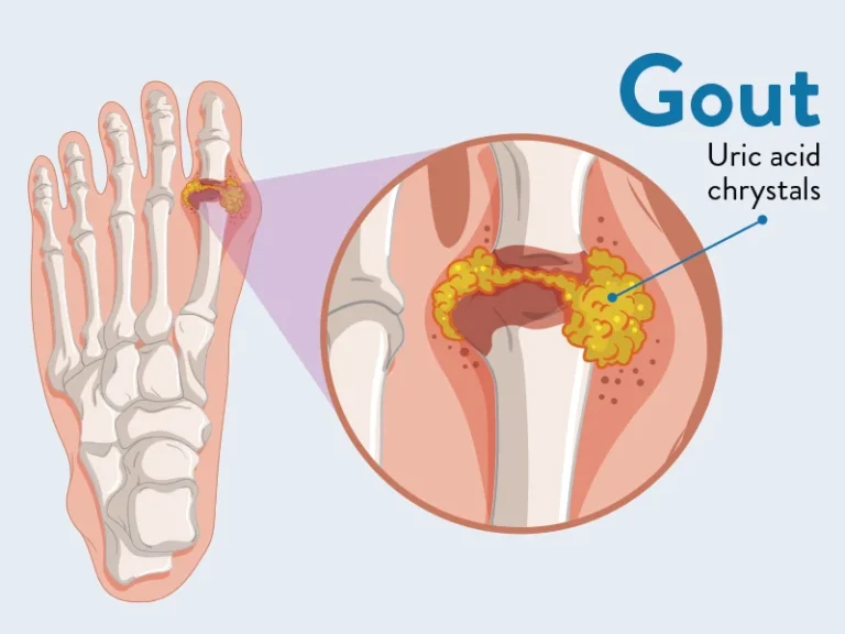 GOUT
