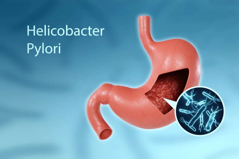 HELICOBACTER PYLORI (H. PYLORI) INFECTION
