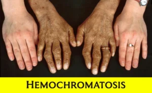 HEMOCHROMATOSIS