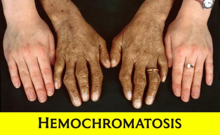 HEMOCHROMATOSIS