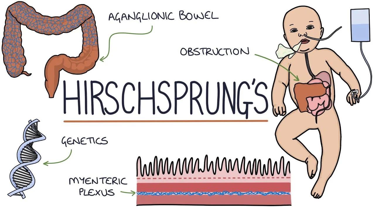 HIRSCHSPRUNG'S DISEASE