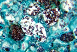 HISTOPLASMOSIS