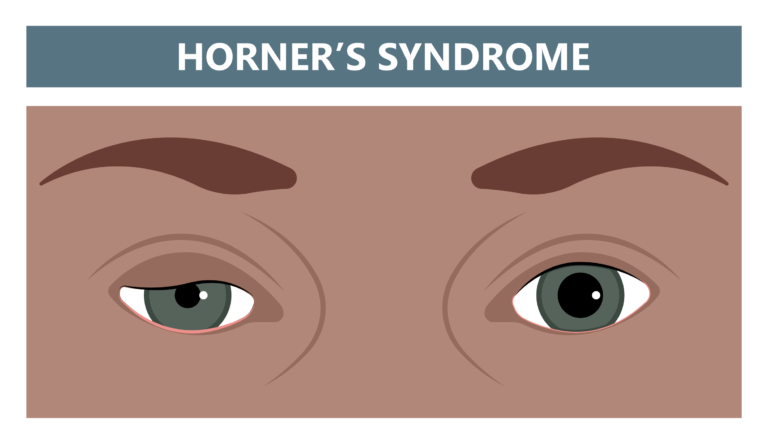 HORNER SYNDROME