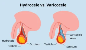 HYDROCELE