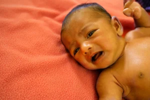 INFANT JAUNDICE