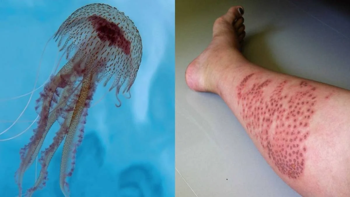 JELLYFISH STINGS