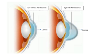KERATOCONUS