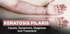 KERATOSIS PILARIS