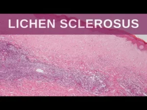 LICHEN SCLEROSUS
