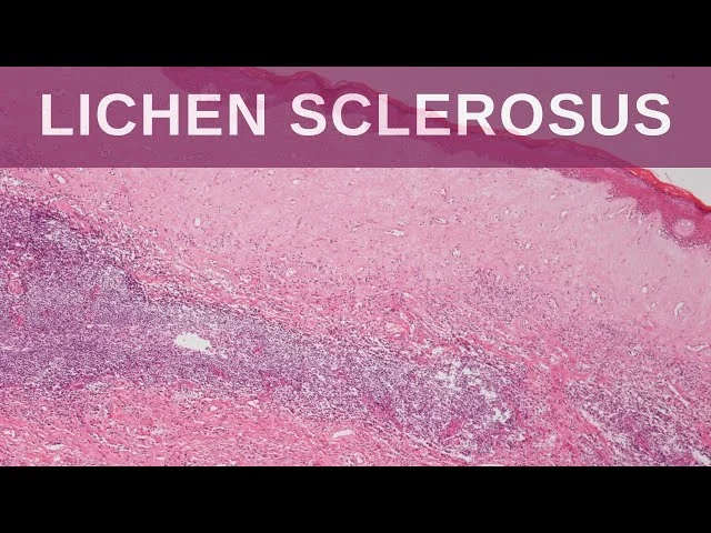 LICHEN SCLEROSUS