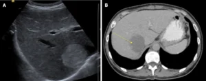 LIVER HEMANGIOMA