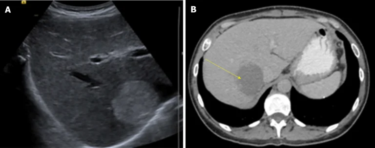LIVER HEMANGIOMA