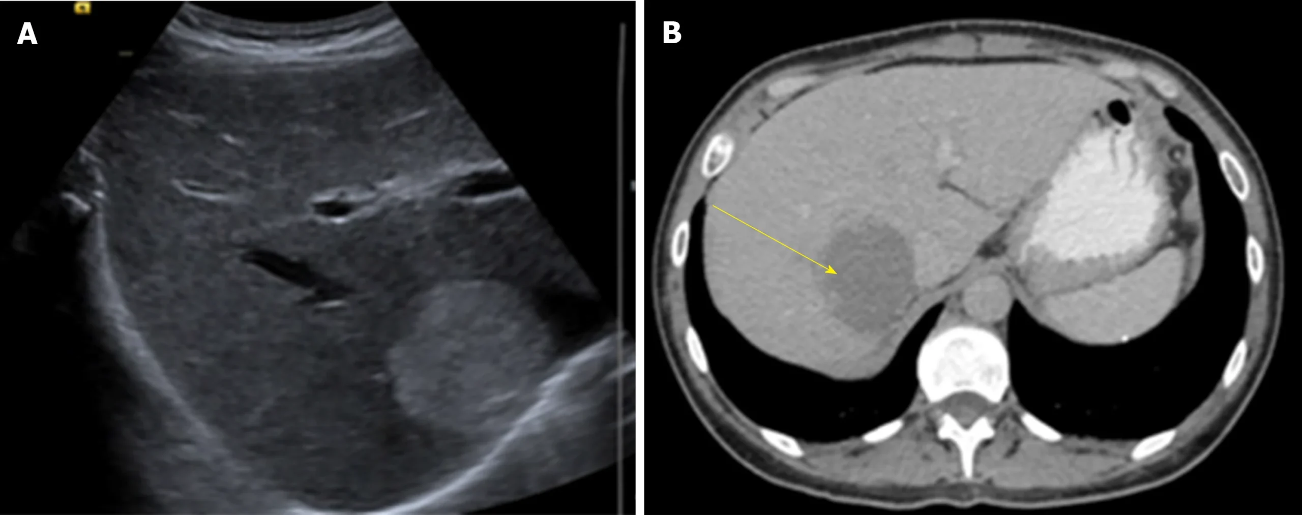 LIVER HEMANGIOMA