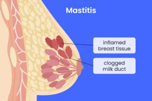 MASTITIS