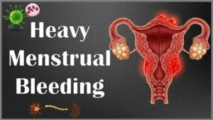 MENORRHAGIA (HEAVY MENSTRUAL BLEEDING)