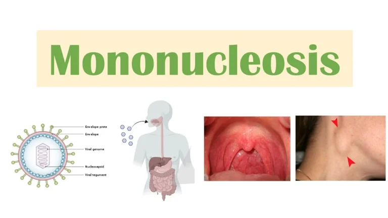 MONONUCLEOSIS