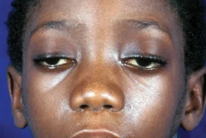 MYASTHENIA GRAVIS