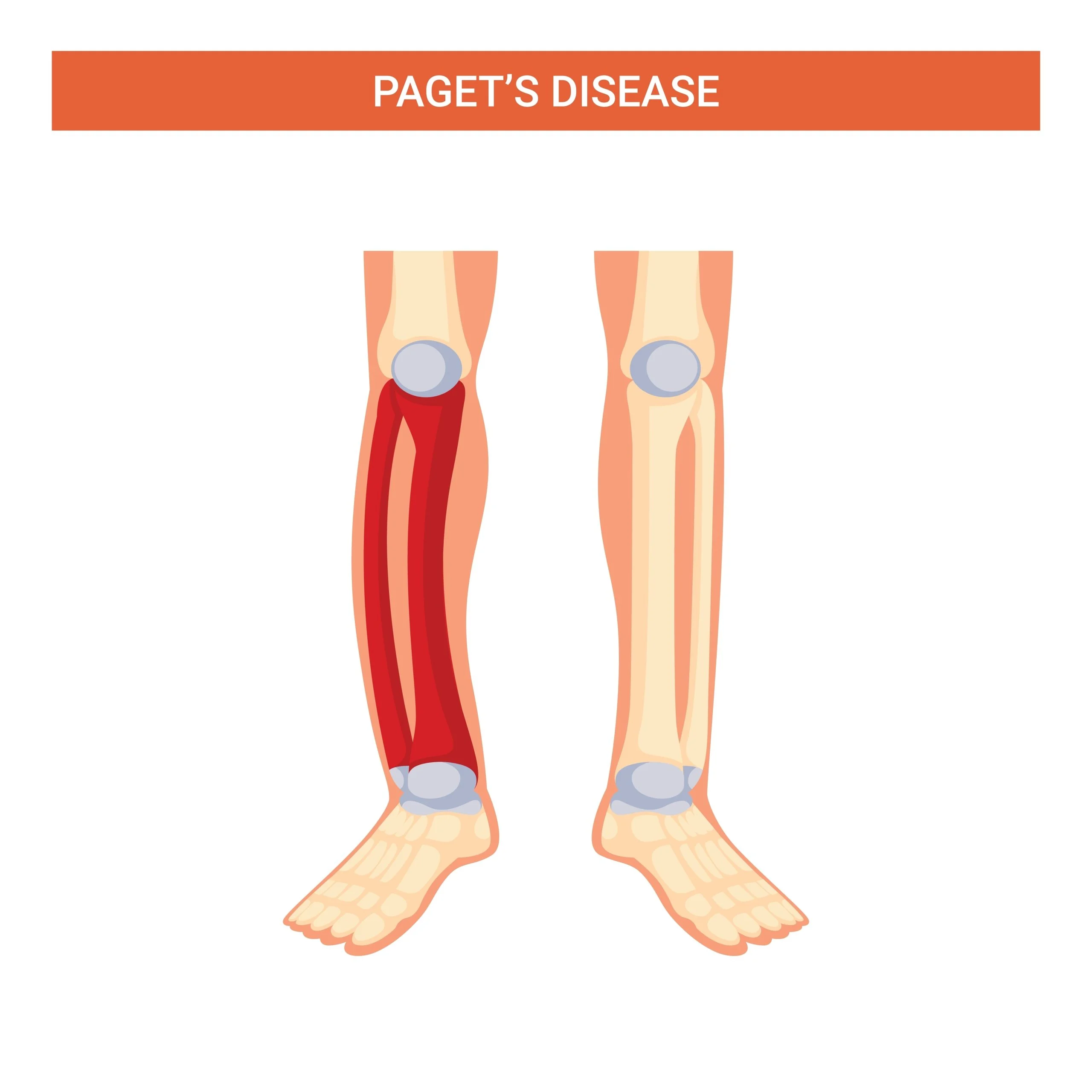 PAGET'S DISEASE