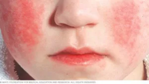 PARVOVIRUS