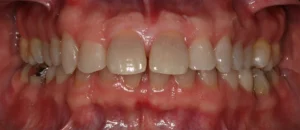 PERIODONTITIS