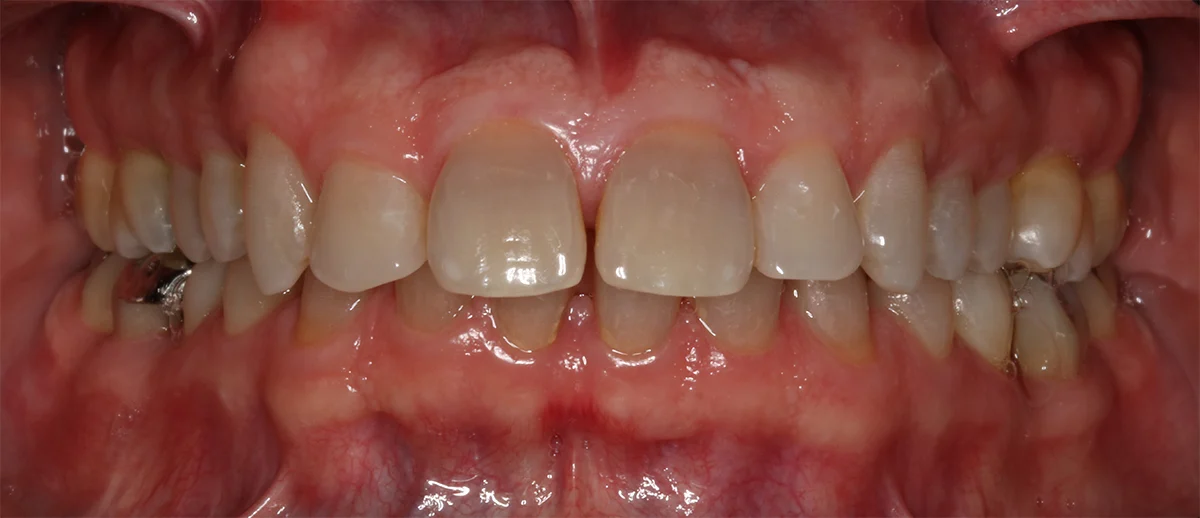 PERIODONTITIS