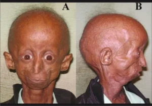PROGERIA