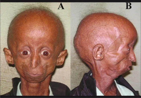 PROGERIA