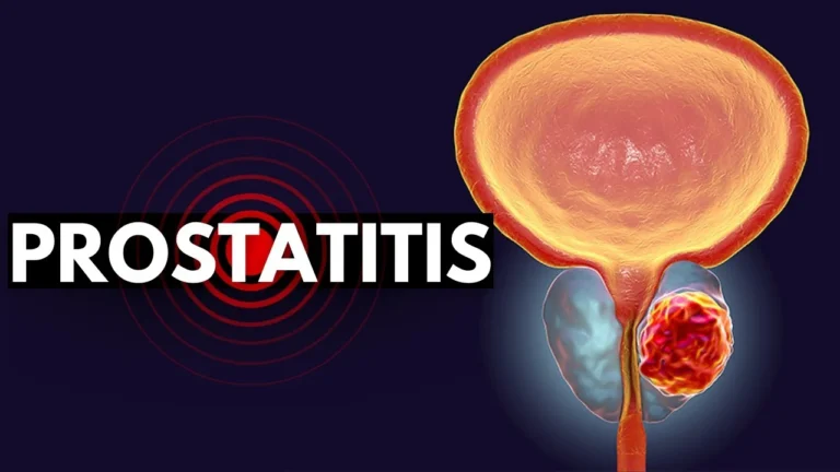 PROSTATITIS