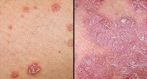 PSORIASIS