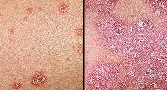 PSORIASIS