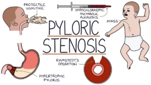 PYLORIC STENOSIS