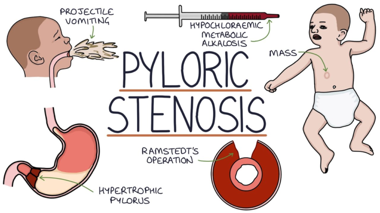 PYLORIC STENOSIS