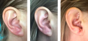 RAMSAY HUNT SYNDROME
