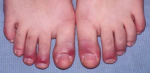 RAYNAUD'S DISEASE