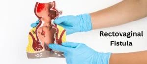 RECTOVAGINAL FISTULA