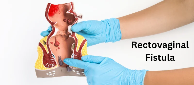 RECTOVAGINAL FISTULA