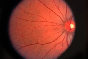 RETINAL DISEASES