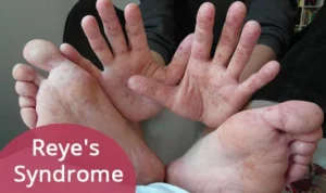 REYE'S SYNDROME