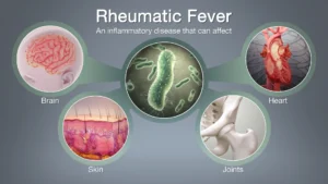 RHEUMATIC FEVER