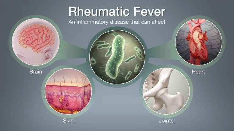 RHEUMATIC FEVER